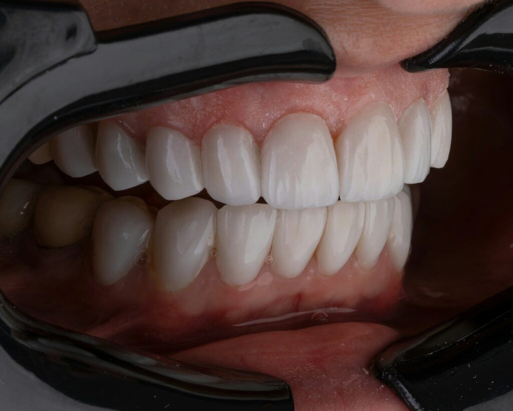 How to Avoid Dry Socket After Tooth Extraction: Proven Tips for Faster Healing how to avoid dry socket
